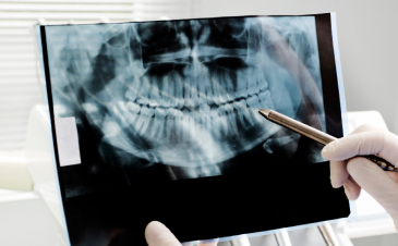 Trattamenti odontoiatrici a Piazzola sul Brenta e Marsango - Chirurgia Orale