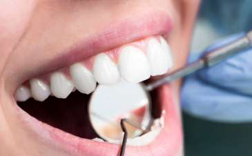 Trattamenti odontoiatrici a Piazzola sul Brenta e Marsango - Igiene Orale