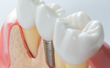 Trattamenti odontoiatrici a Piazzola sul Brenta e Marsango - Implantologia