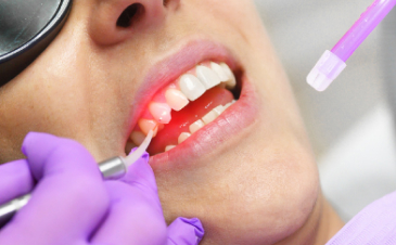 Trattamenti odontoiatrici a Piazzola sul Brenta e Marsango - Laserterapia Dentale