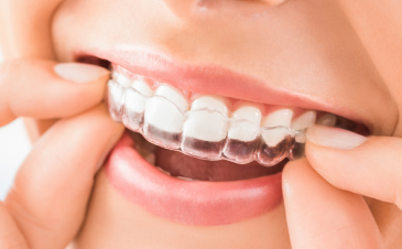 Trattamenti odontoiatrici a Piazzola sul Brenta e Marsango - Ortodonzia