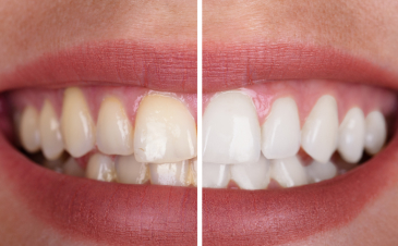 Trattamenti odontoiatrici a Piazzola sul Brenta e Marsango - Sbiancamento dentale